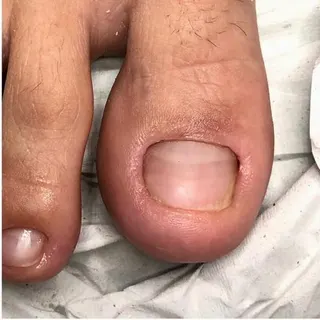 Unhas com fungo — depois do tratamento