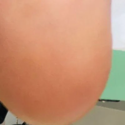 Fissuras e ressecamento — depois do tratamento